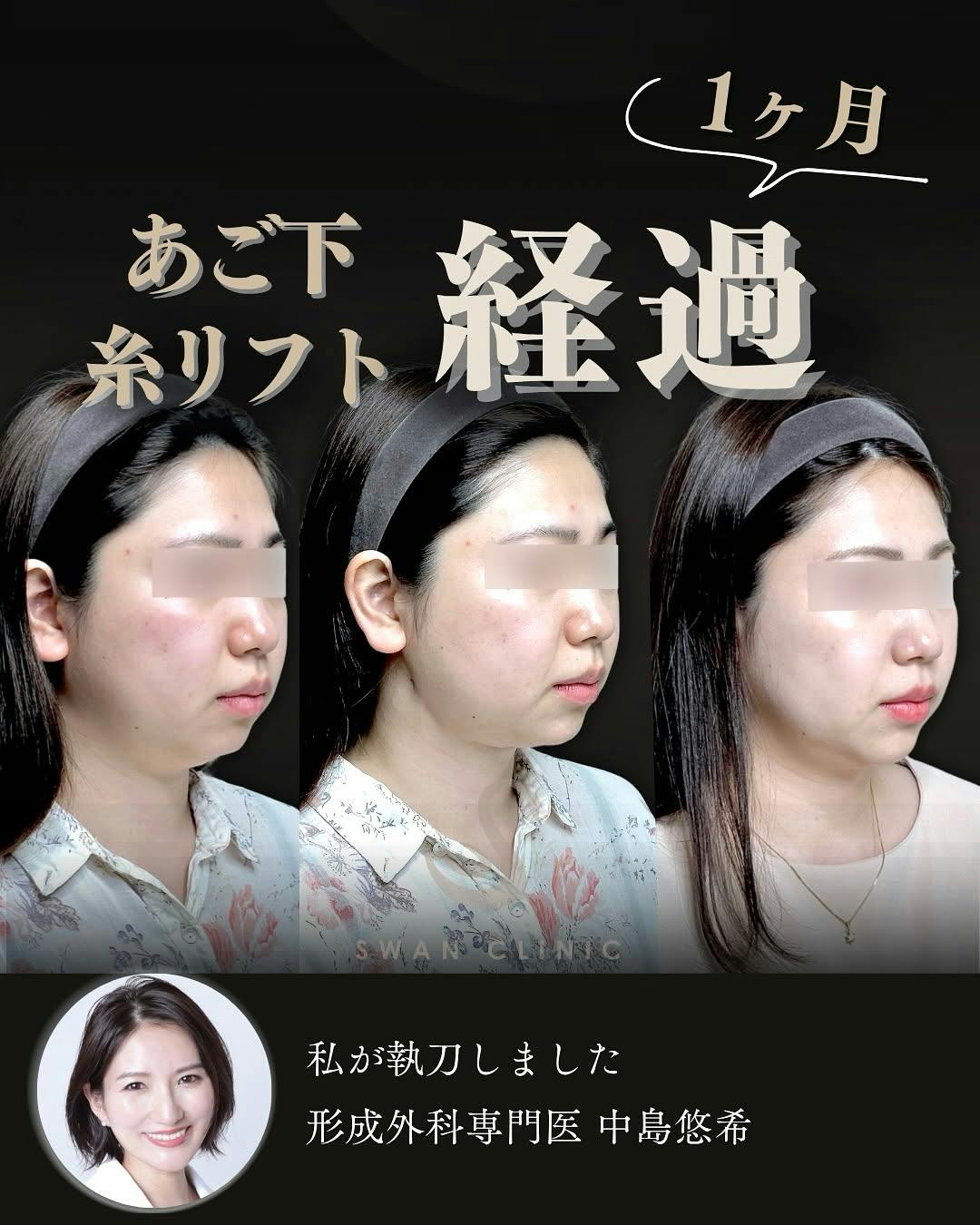 【女性・顎下】糸リフト 顎ヒアルロン酸注入_before_aftar