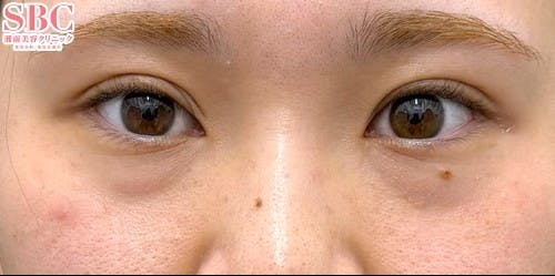 【20代女性・目元】裏ハムラ法 ナチュラル脂肪注射ナノリッチ VOV（ボブ）リフト_before