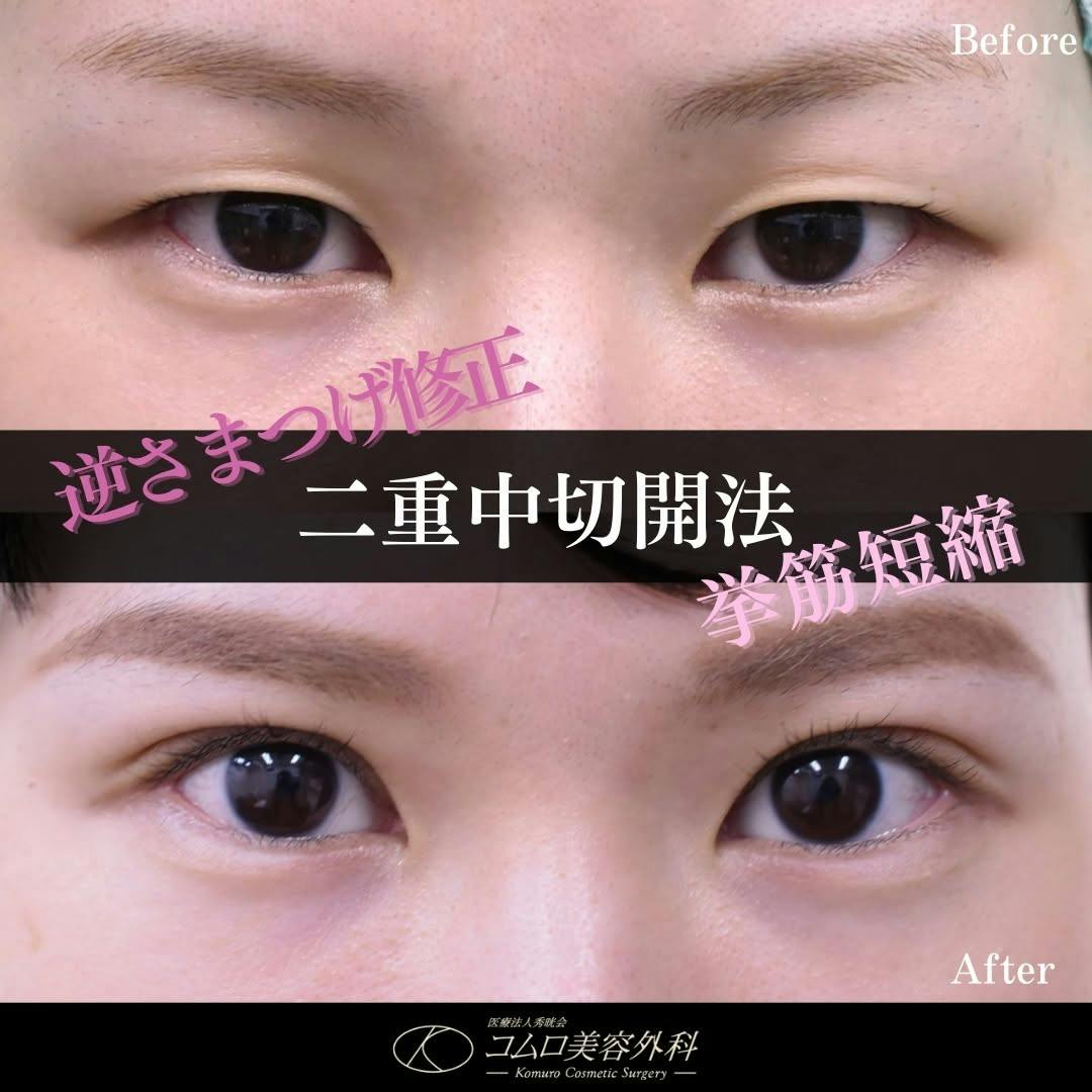 【30代女性・目元】二重中切開法・逆さまつげ修正・挙筋短縮_before_aftar