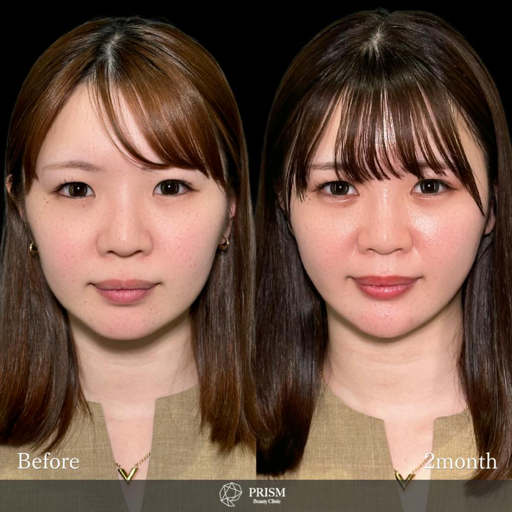 【20代女性・顔】脂肪吸引プレミアム（頬・顎下）+ 糸リフト+メーラーファット除去+あご先リフト_before_aftar