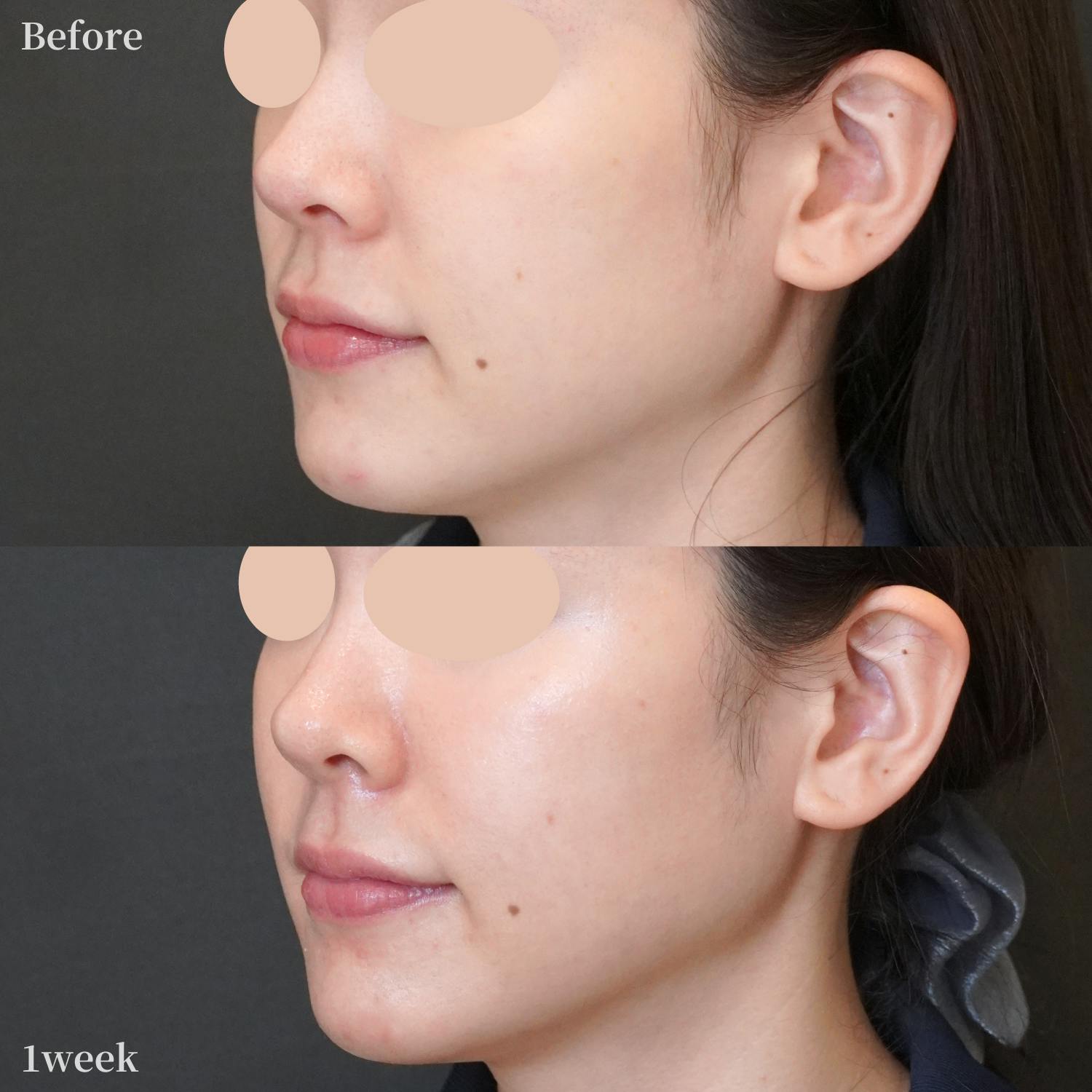 オリジオkiss_before_after