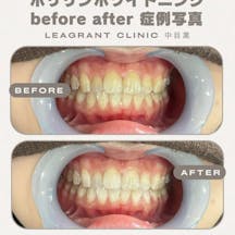 【20代女性・歯】ポリリンホワイトニング_before_aftar