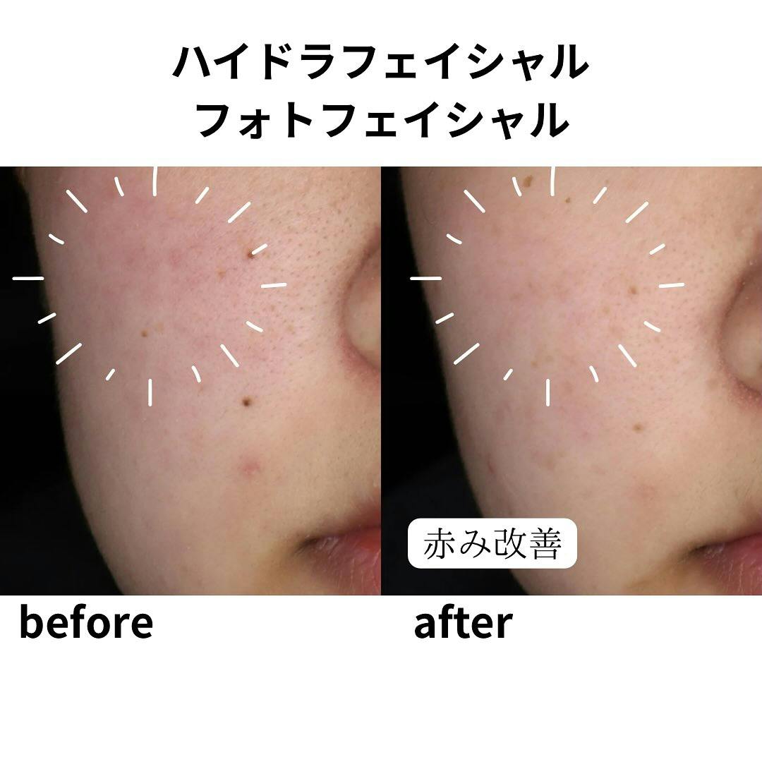 【女性・顔】フォトフェイシャル、ハイドラフェイシャル_before_aftar