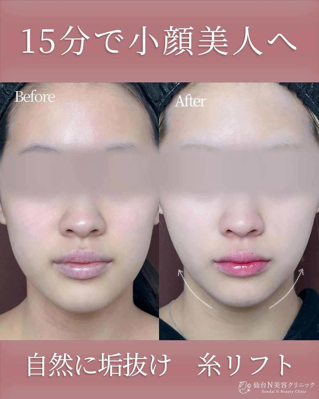 【女性・輪郭】糸リフト_before_aftar