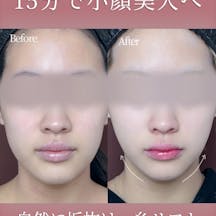 【女性・輪郭】糸リフト_before_aftar