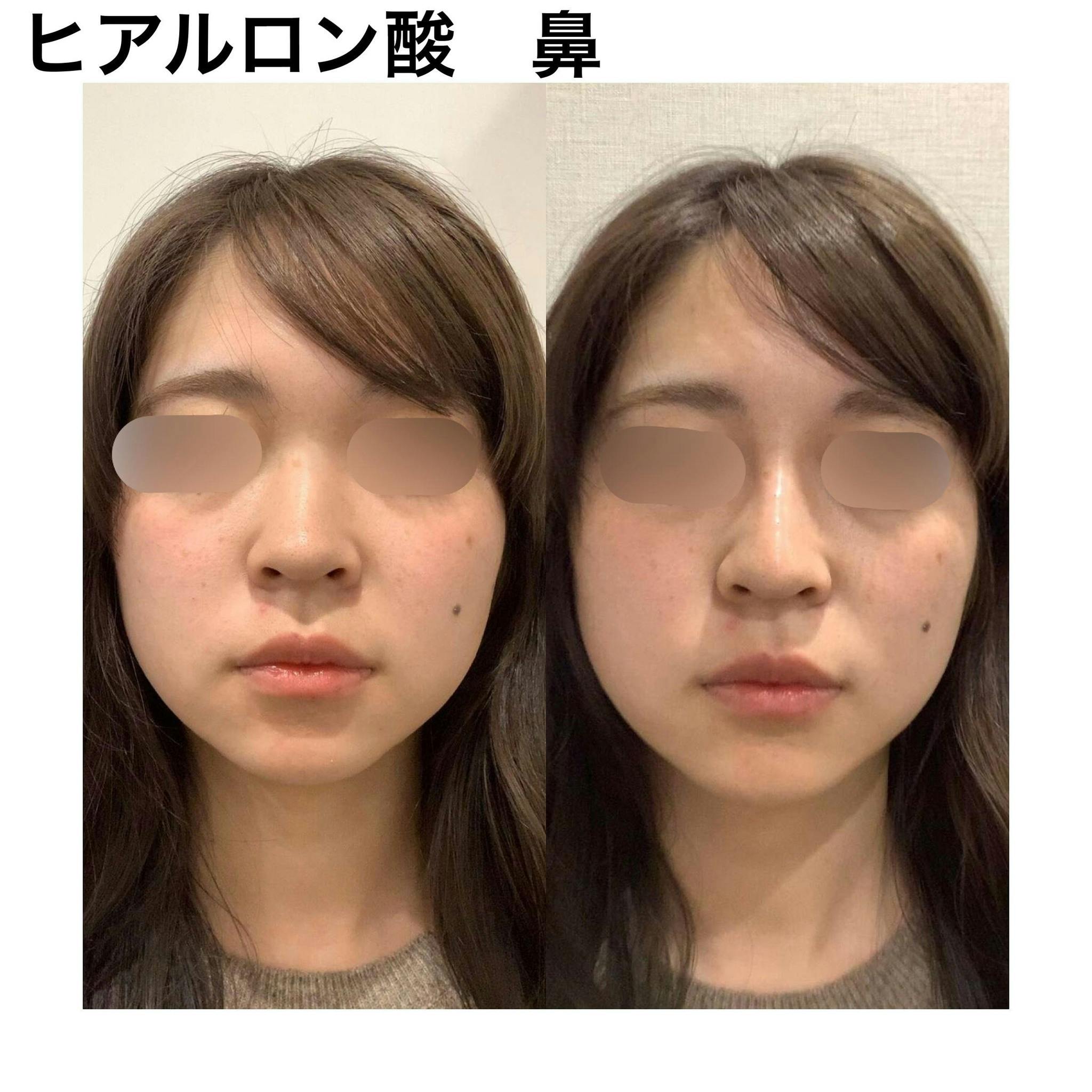 【女性・鼻】ヒアルロン酸（鼻）_before_aftar