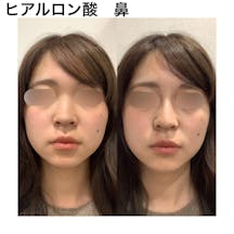 【女性・鼻】ヒアルロン酸(鼻)_before_aftar