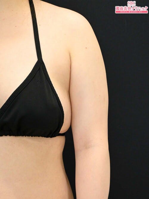 【20代女性・二の腕】クールスカルプティング(R)・ エリート（クルスカダブル） サクセンダ_before