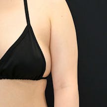 【20代女性・二の腕】クールスカルプティング(R)・ エリート(クルスカダブル) サクセンダ_before