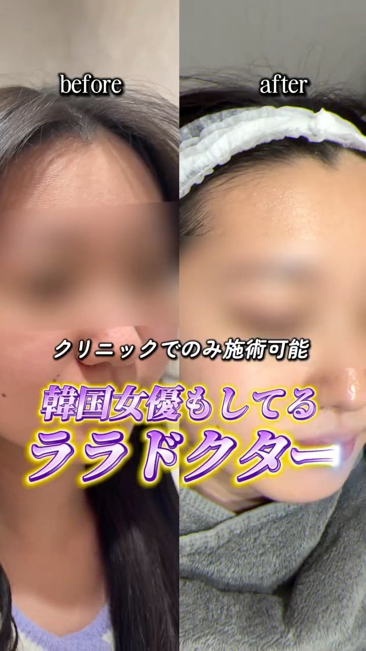 【女性・ハリ】ララドクター_before_aftar