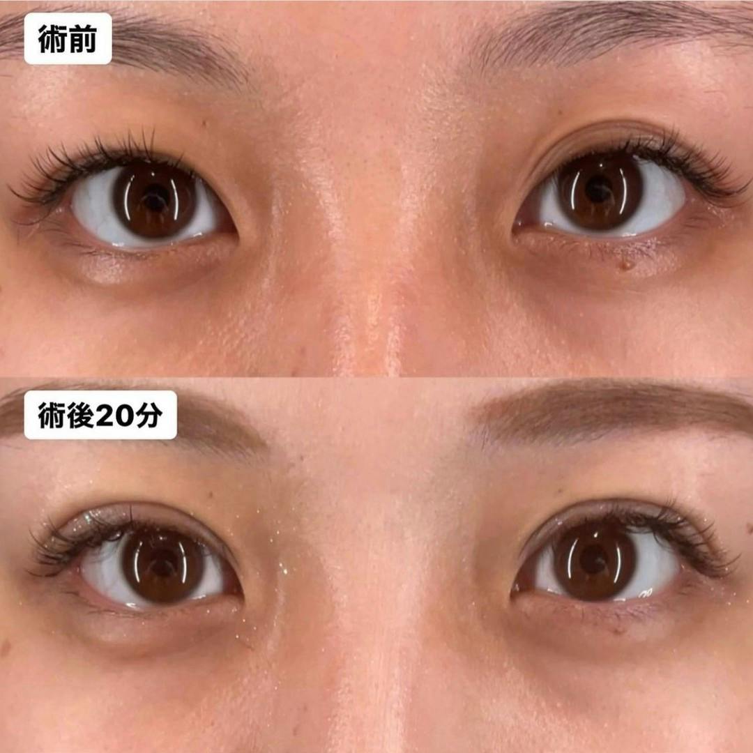 【女性・目元】Xクロストリプル_before_aftar