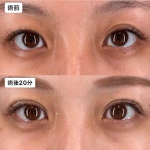 【女性・目元】Xクロストリプル_before_aftar