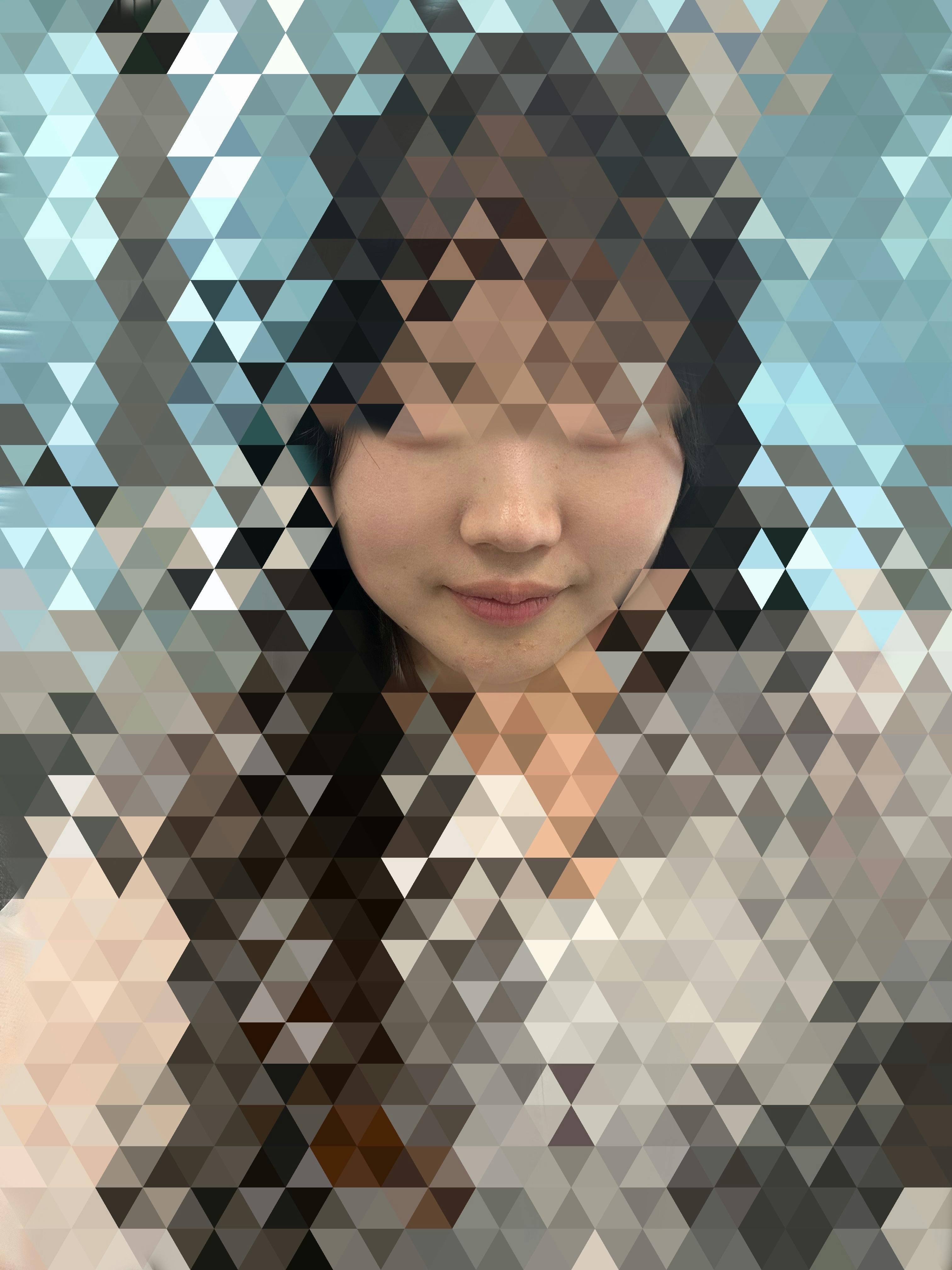 渋谷美容外科クリニック 横浜院でを受けたちゃんひなさんの写真