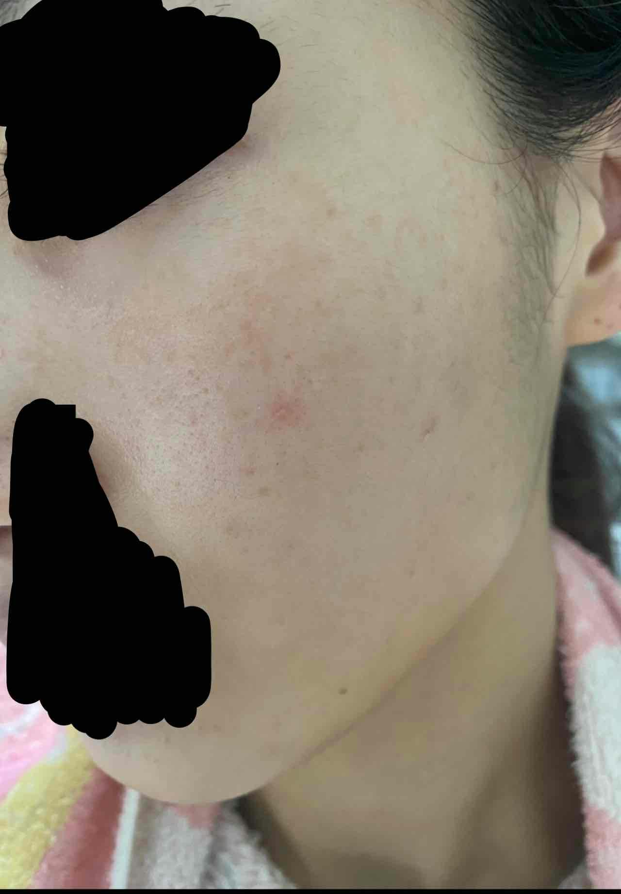 上野病院でピコスポットを受けたぴょんさんの写真