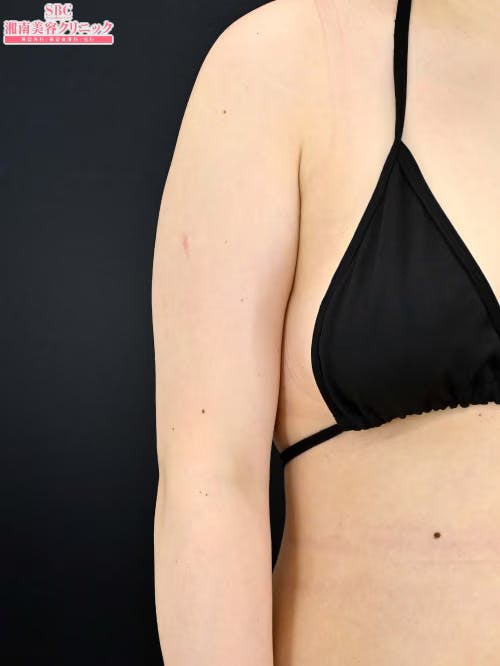 【20代女性・二の腕】クールスカルプティング(R)・ エリート（クルスカダブル） サクセンダ_after