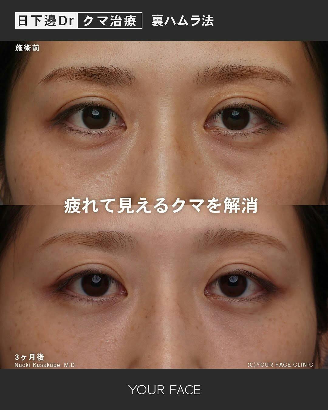 【女性・クマ】裏ハムラ法_before_aftar