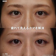 【女性・クマ】裏ハムラ法_before_aftar