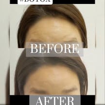 【女性・しわ】BOTOX_before_aftar