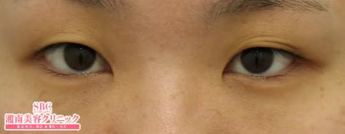 【女性・目元】クイックコスメティーク・ダブルNeo、自然癒着セット（上眼瞼脱脂）、SBC『デカ目』術_before
