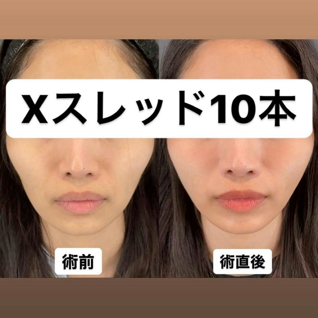 【女性・輪郭】糸リフト(Ⅹスレッド)_before_aftar