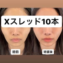 【女性・輪郭】糸リフト(Ⅹスレッド)_before_aftar