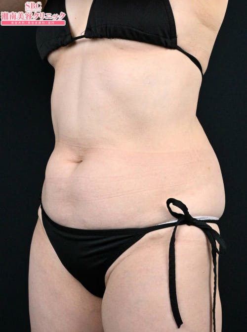 【50代女性・腹部】ダイエット注射 MITI（マイティ）_before