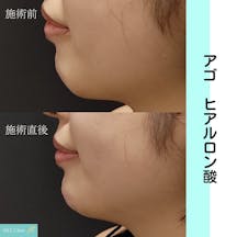 【女性・アゴ】ヒアルロン酸_before_aftar