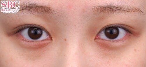 【20代女性・目元】クイックコスメティーク・トリプルNeo_before