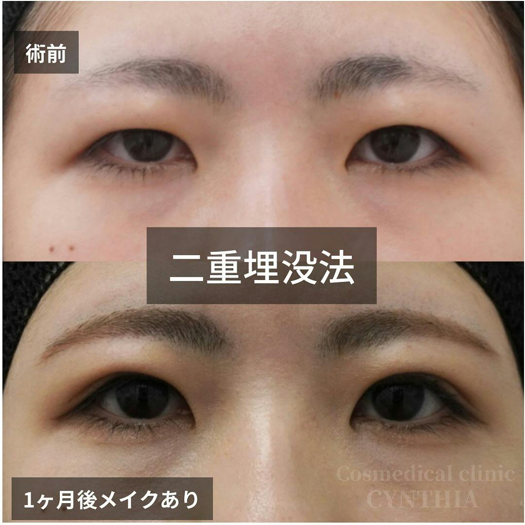 【10代女性・目元】二重埋没法_before_aftar