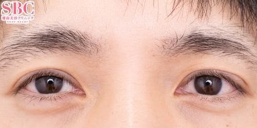 【40代男性・目元】眼瞼下垂＋二重_after