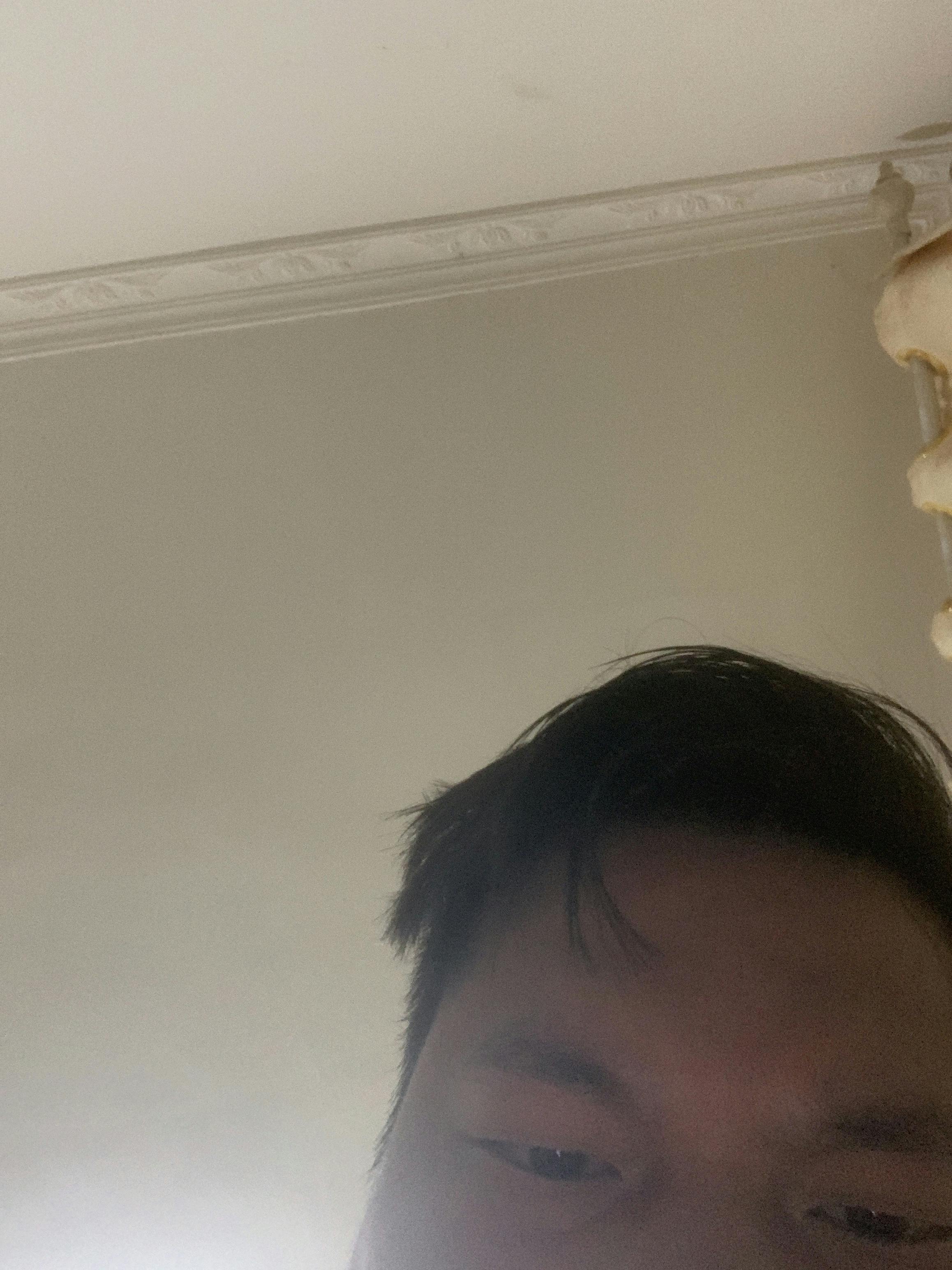 TCB東京中央美容外科 宮崎院で他院修正(二重)・他院抜糸・二重整形を受けたHhghhさんの写真