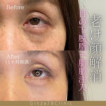 【女性・目元】脱脂・目の下脂肪注入_before_aftar