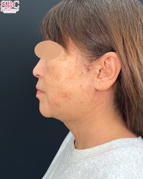 【女性・輪郭】根こそぎVASER脂肪吸引_after