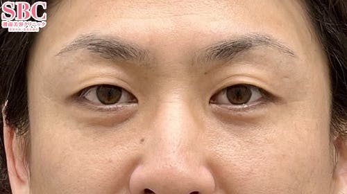 【男性・目元】ナチュラル脂肪注射コンデンスリッチ ナチュラル脂肪注射ナノリッチ 目の下の切らないクマ・たるみ（ふくらみ）取り_after