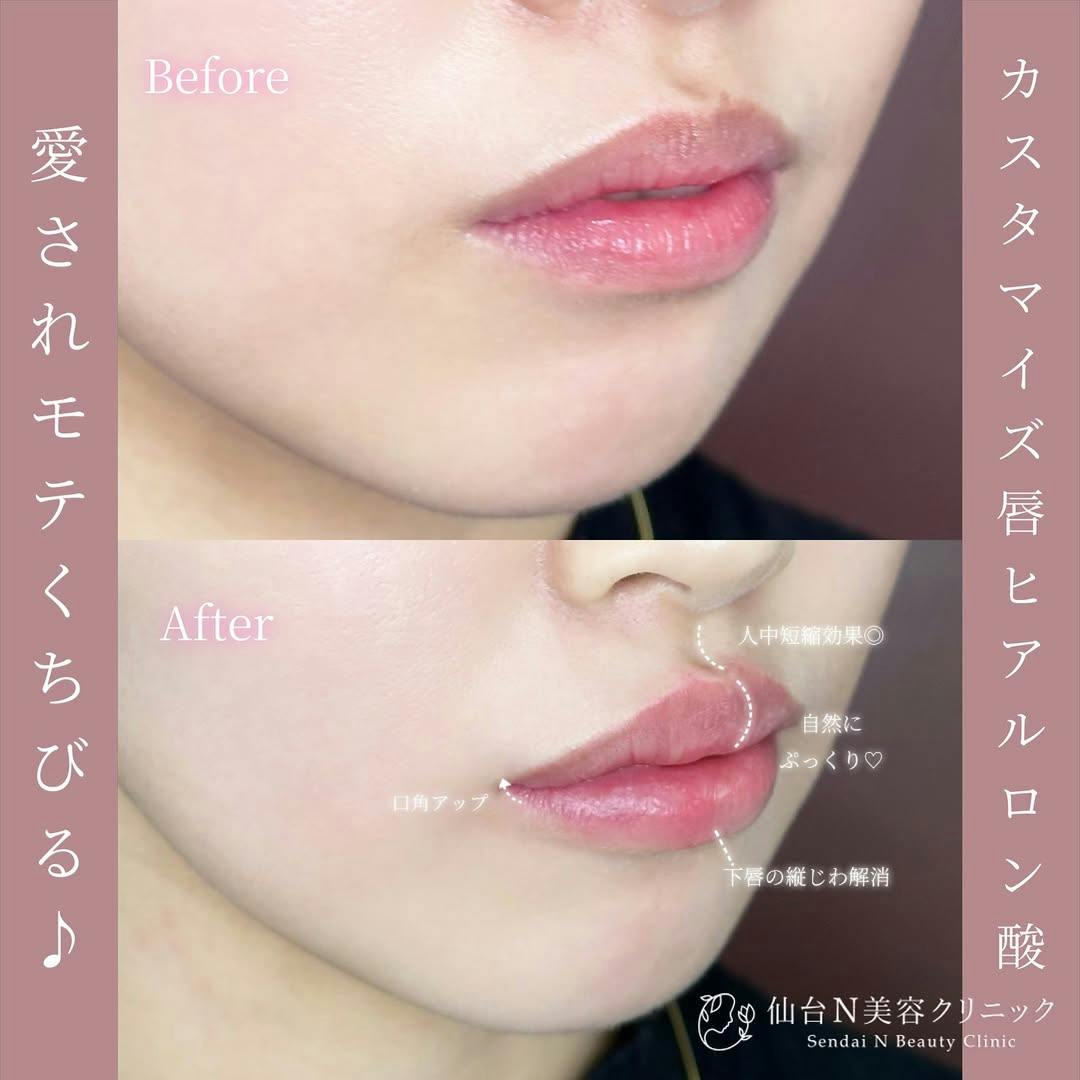 【女性・唇】ヒアルロン酸　ボルベラ　1㏄_before_aftar