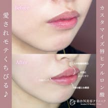 【女性・唇】ヒアルロン酸 ボルベラ 1㏄_before_aftar