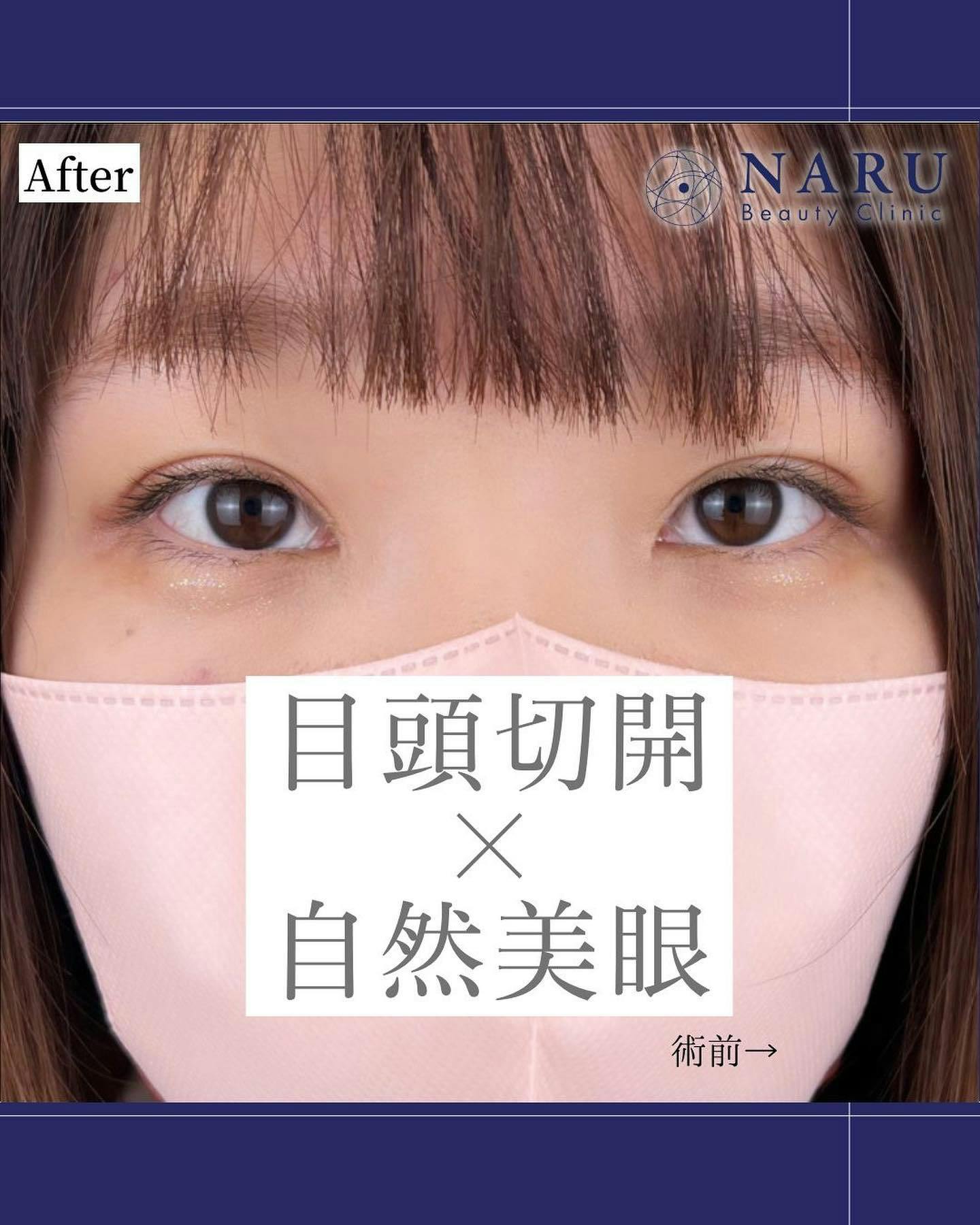 【女性・目元】二重埋没法_after