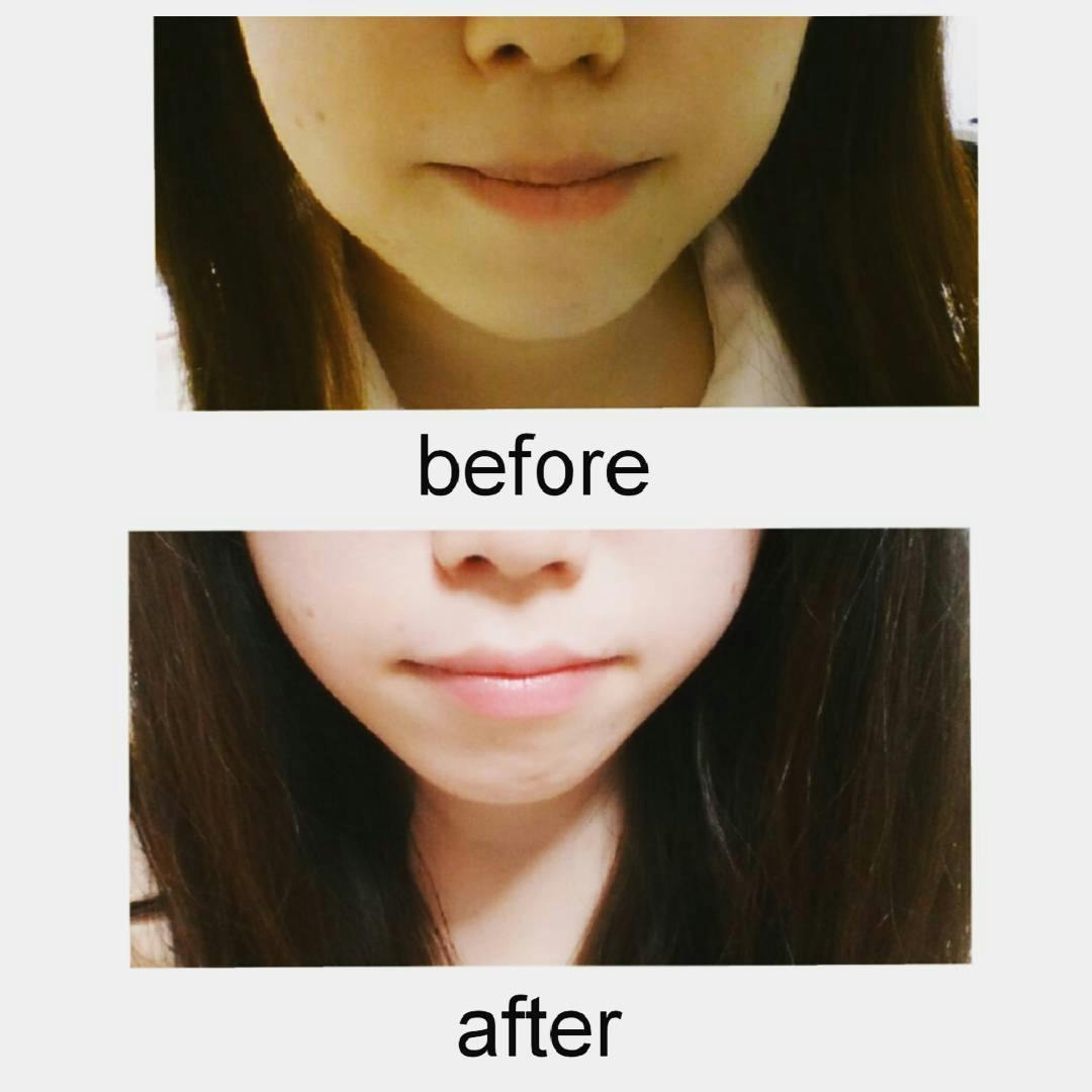 【女性・輪郭】小顔注射_before_aftar