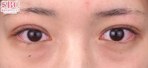 【20代女性・目元】クイックコスメティーク・トリプルNeo_0day