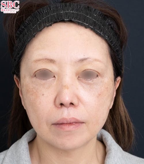 【40代女性・顔】アイバックリムーブ法、VASER併用アキーセル脂肪吸引、ナチュラル脂肪注射コンデンスリッチ、ナチュラル脂肪注射ナノリッチ、SBCプリマリフト、シークレットリフト、VOVリフト_before