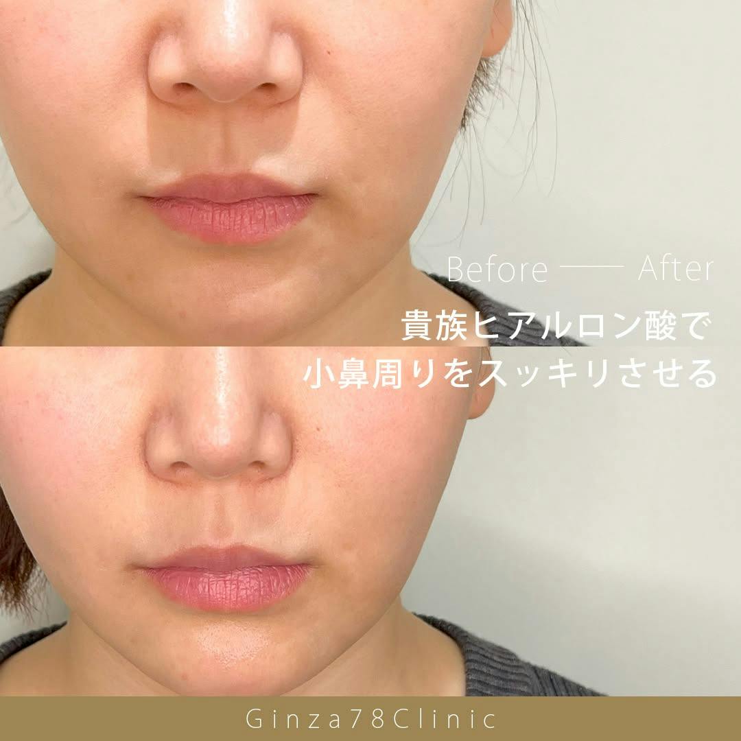 貴族ヒアルロン酸 | ニューラミス 1cc】の予約｜Ginza78Clinic(銀座