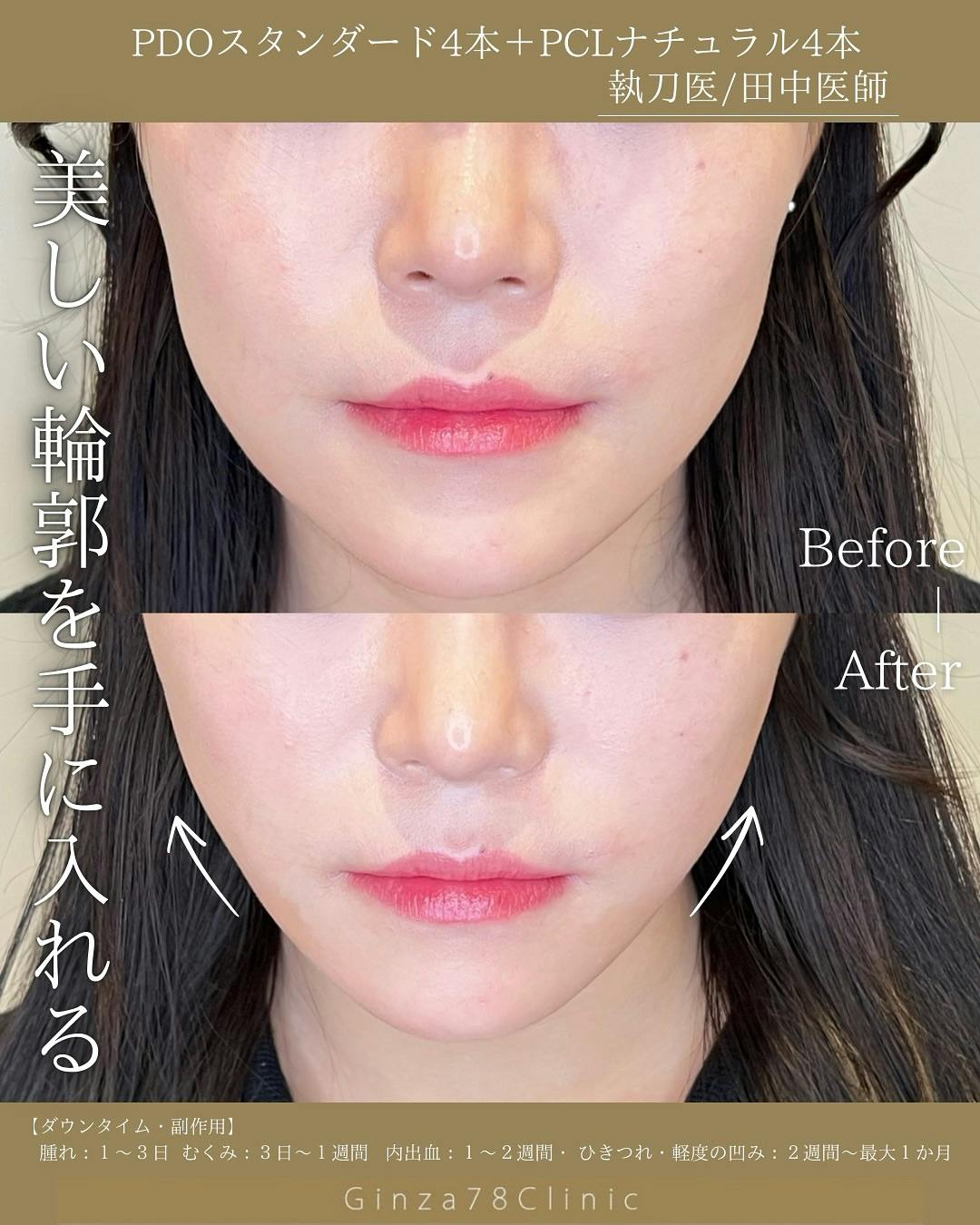 糸リフト(スレッドリフト)の症例写真・ビフォーアフター画像No.2495