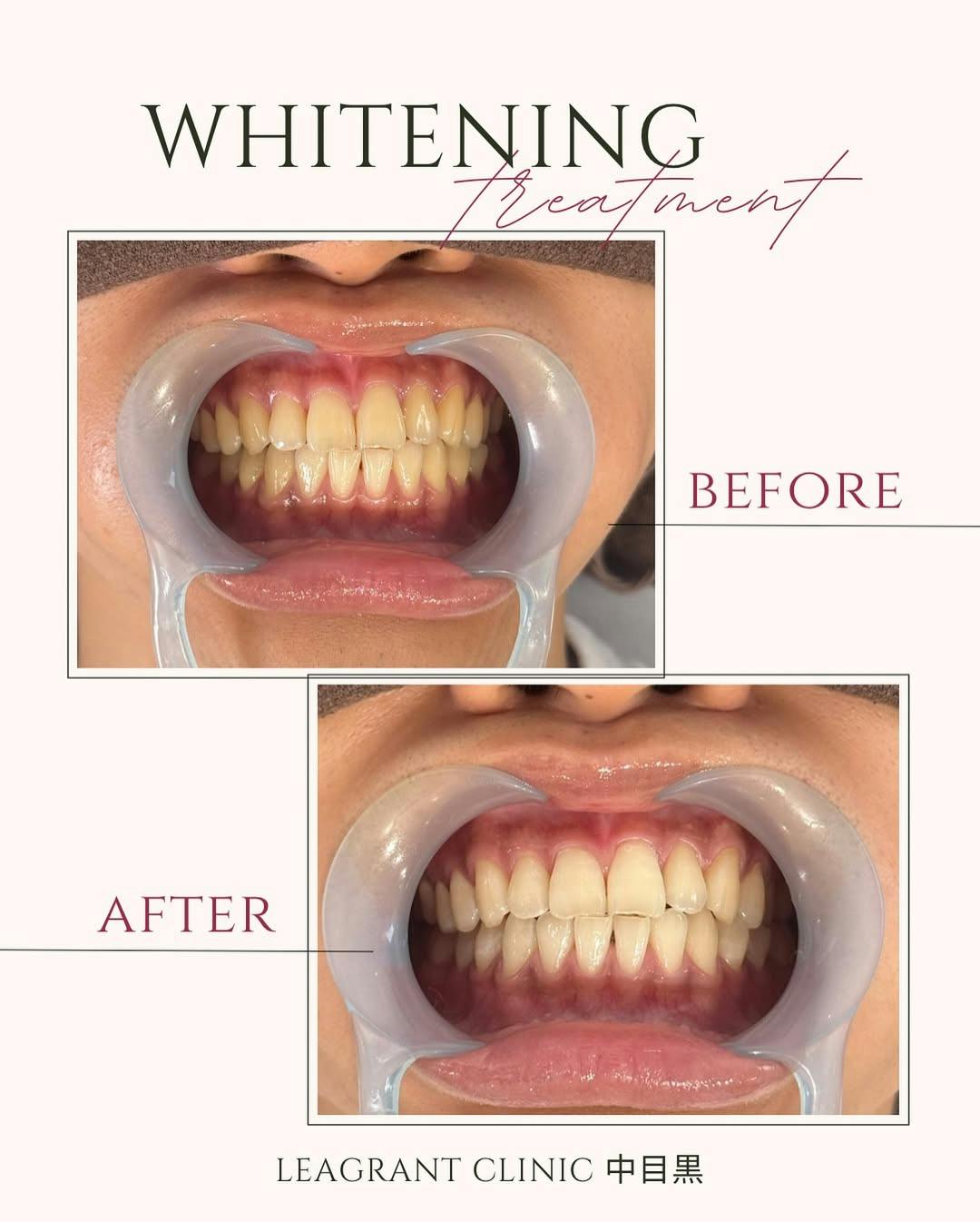 【20代男性・歯】ポリリンホワイトニング_before_aftar