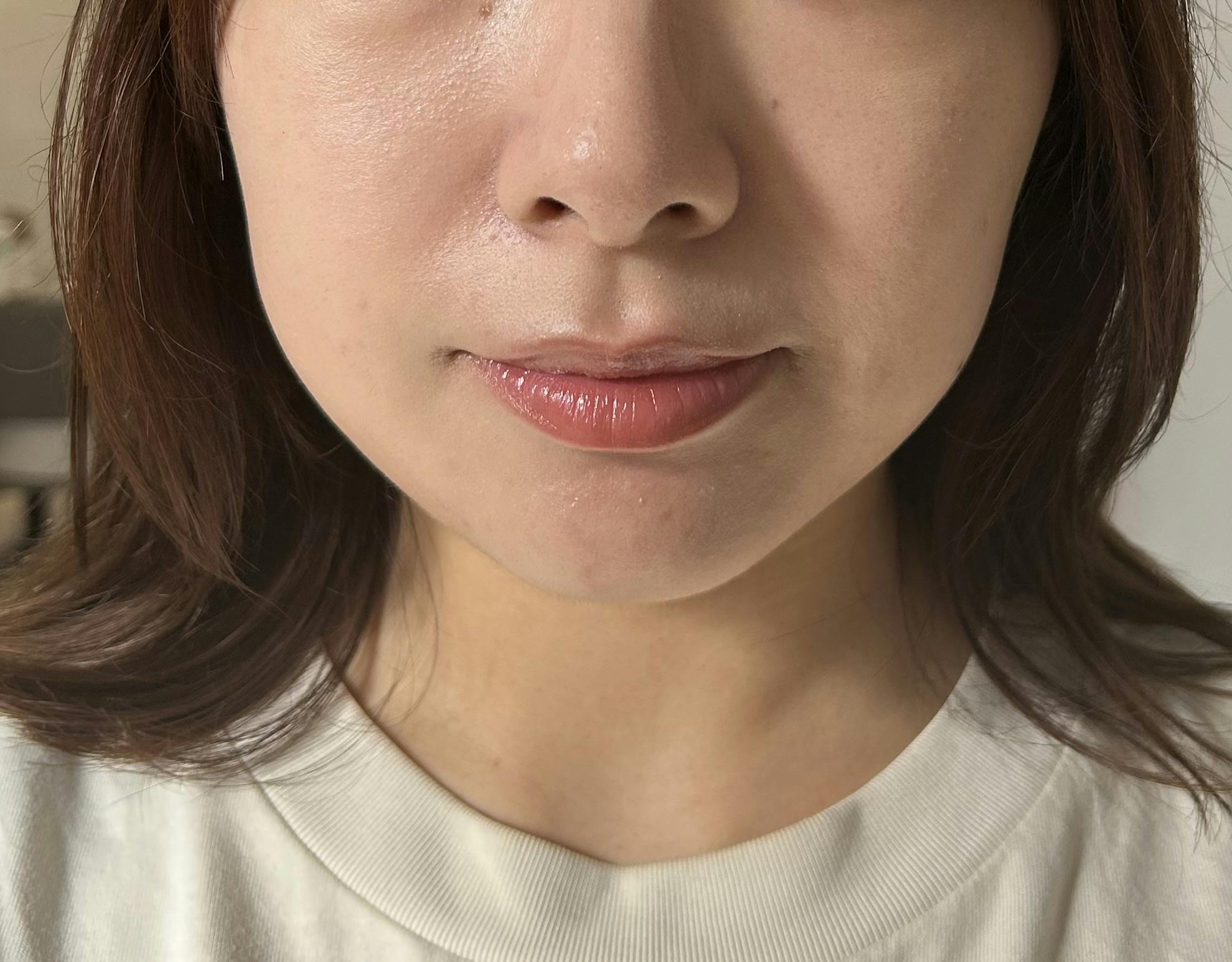 湘南美容クリニック 福井院でボトックス注射・エラボトックス注射(小顔)・韓国製ボトックス・ボツリヌストキシン・アラガン製ボトックスを受けたおもちさんの写真