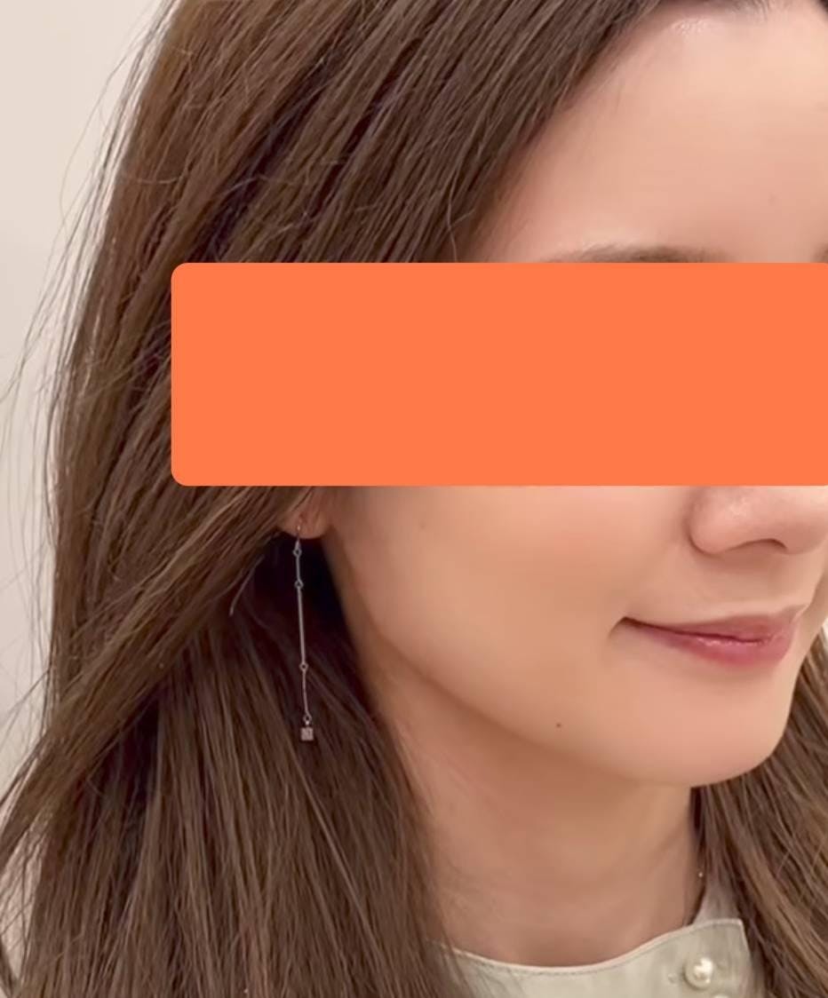 湘南美容クリニック 北千住院で注射治療(ボトックス・ヒアルロン酸)：エラボトックス注射（アラガン）を受けたCindyさんの写真