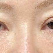 【50代女性・目元・顔】目の下の切らないクマ・たるみ(ふくらみ)取り、ナチュラル脂肪注射入れ放題、プロファイロ_after