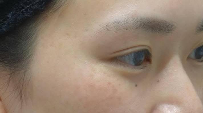 湘南美容クリニック 新百合ヶ丘院で美容点滴・注射：白玉注射（ダブル）を受けたまゆさんの写真