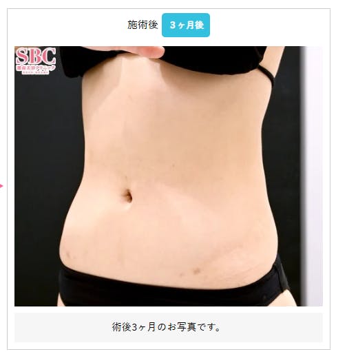 【女性・腹部】根こそぎVASER脂肪吸引_aftar