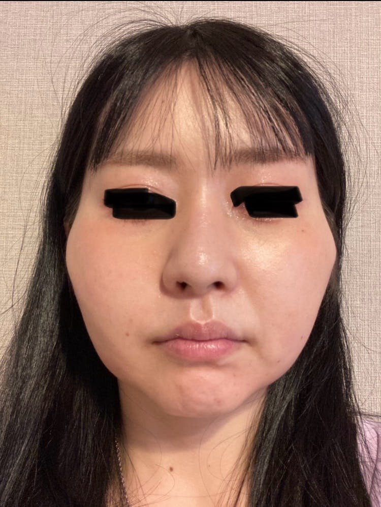聖心美容クリニック 銀座院でヒアルロン酸分解注射・他院修正を受けたpeanutsさんの写真