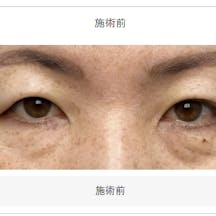 【40代女性・目元】クイックコスメティーク・ダブルNeo SBC『デカ目』術_before